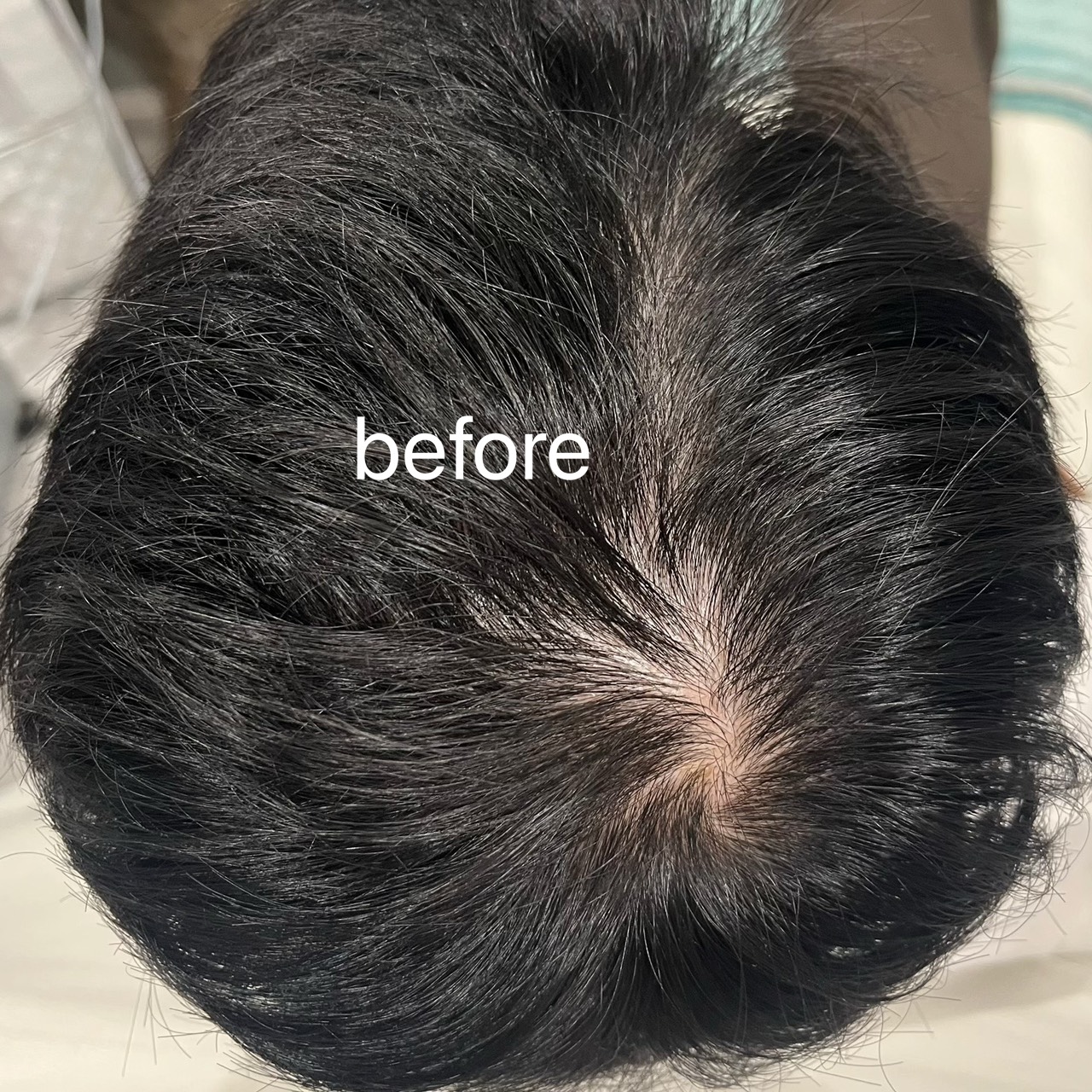 頭皮のアートメイク,Before