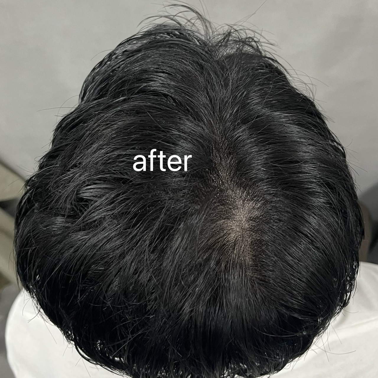 頭皮のアートメイク,After