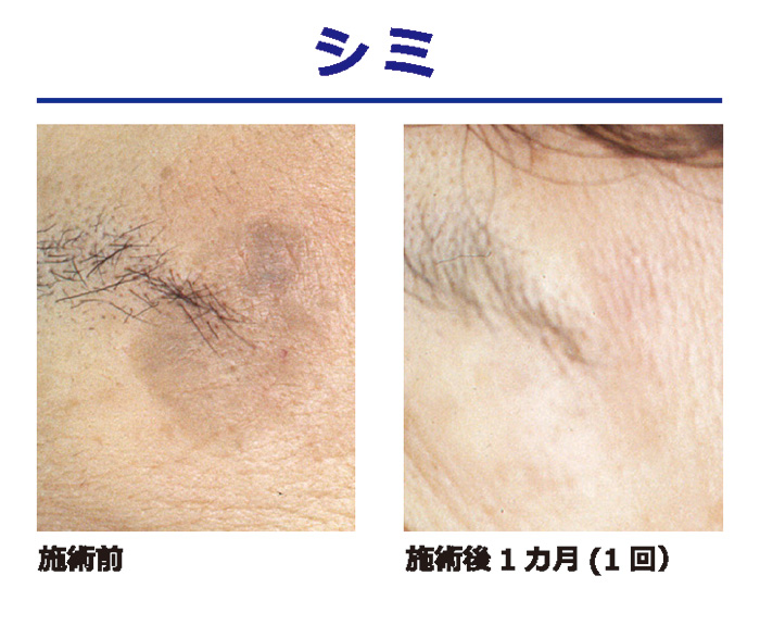 症例２